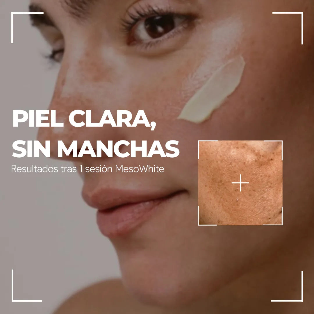 CÉLULAS MADRE MESOWHITE – ACLARADO Y LUMINOSIDAD SIN AGUJAS